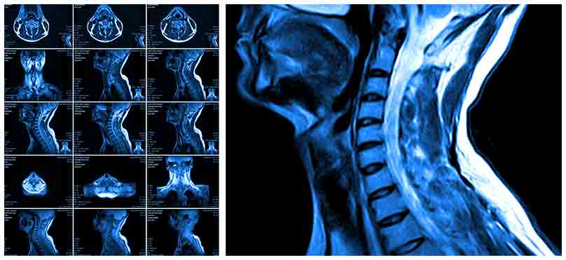 NJ spinal cord injury lawyers