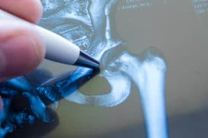 Metal Hip and Knee Replacements Pose Risks Patients’ Health