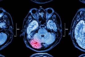 Failure to Diagnose Traumatic Brain Injury and the Consequences