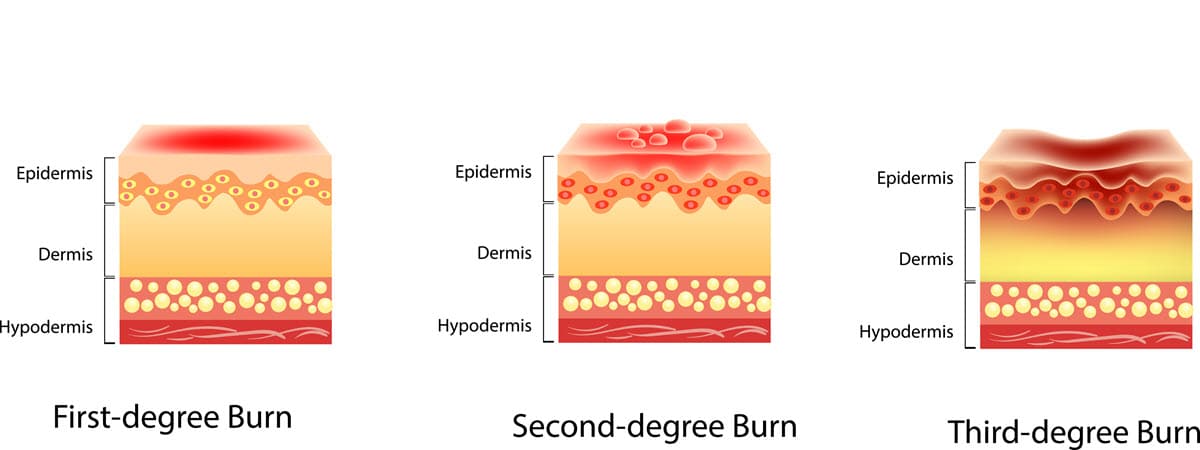 burn injuries truck accident