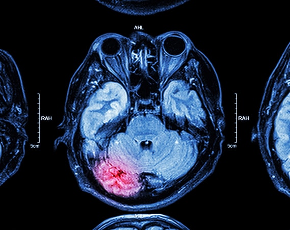 Brain-injury-scan