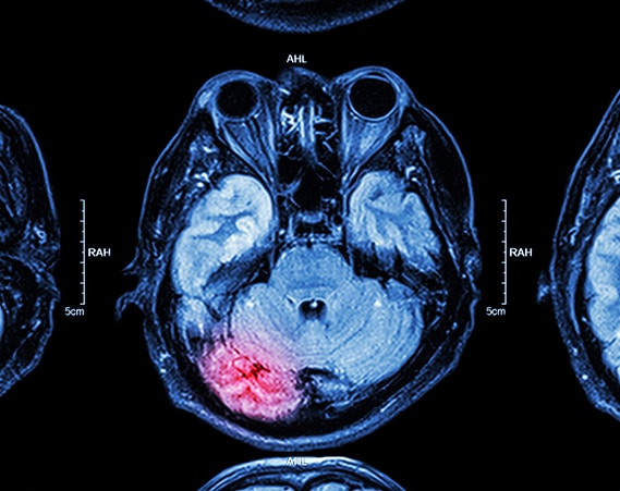 Brain-injury-scan Brain-injury-scan
